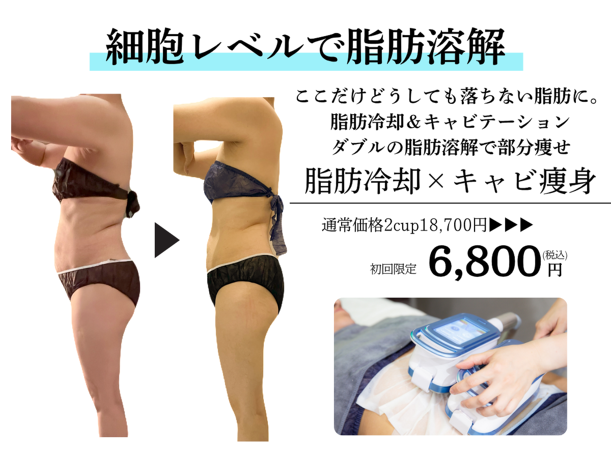 脂肪冷却キャビ痩身