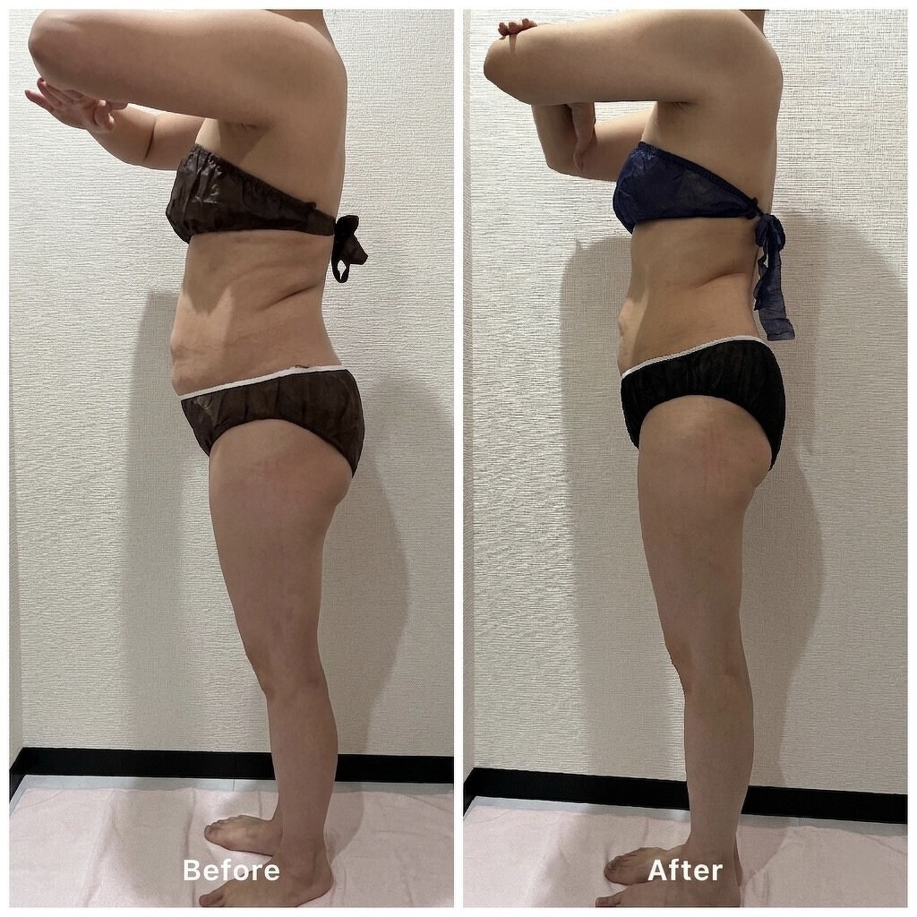 脂肪冷却3回＆テトラセレスト痩身3回